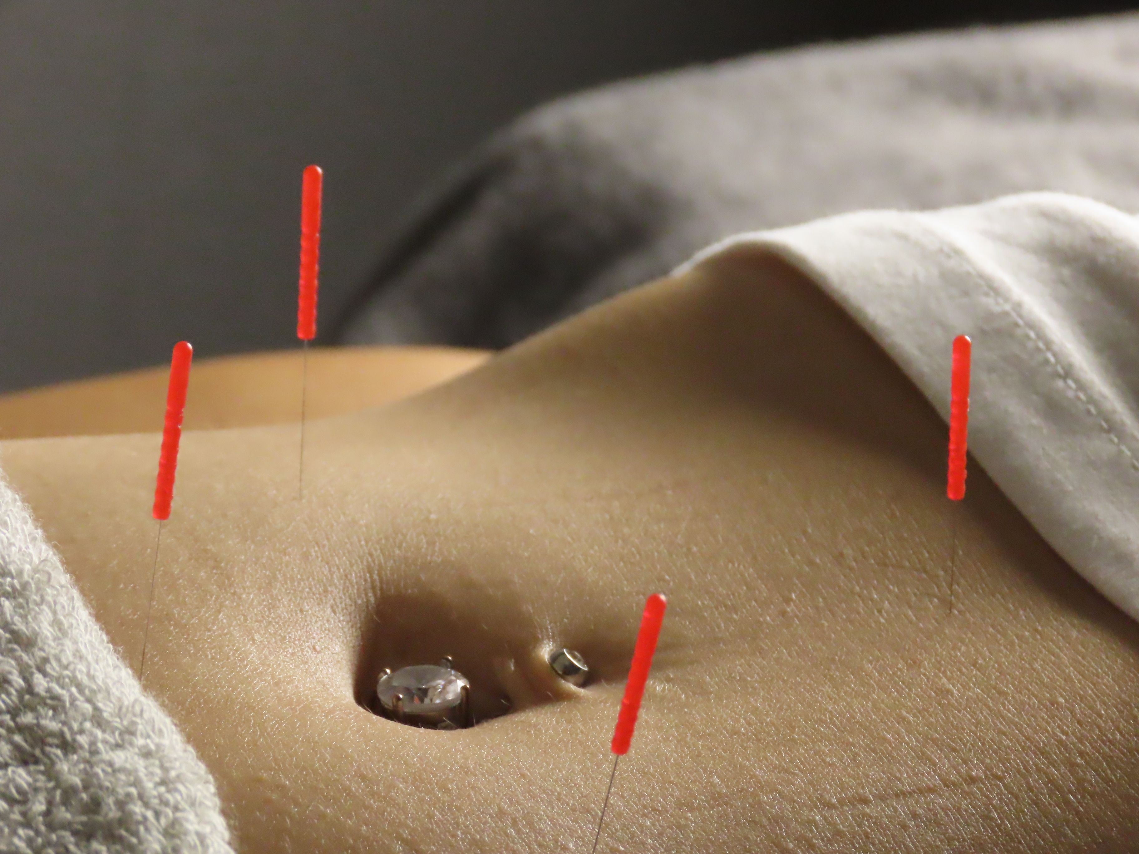 Hari-Slim 腹部鍼施術