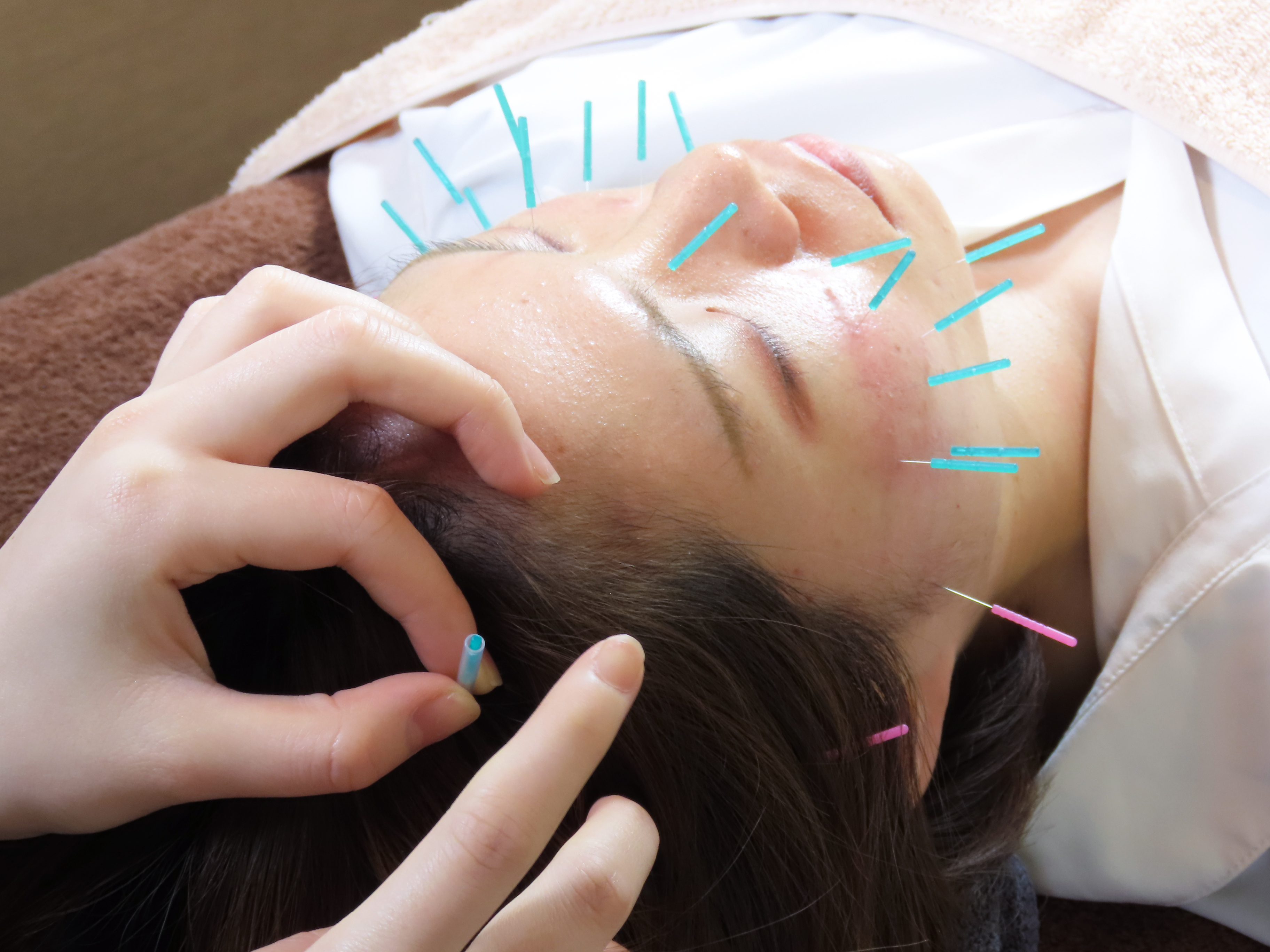 EXO美容鍼 施術風景